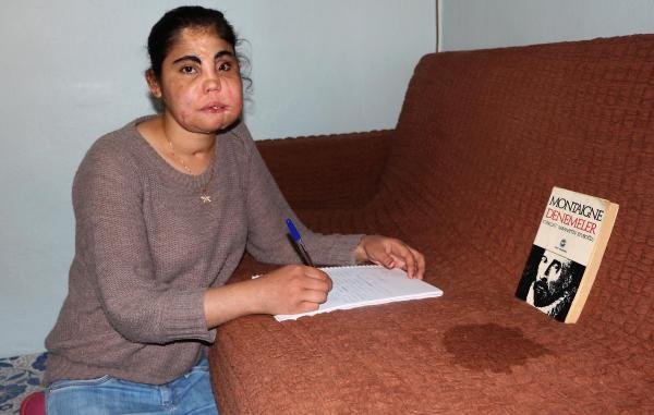 Türkiye'de yüz nakli olan ilk kadın hayatını kaybetti